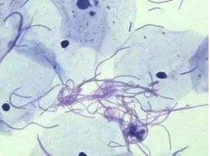 陰道分泌物香蕉爱视频APP廠家探討白帶清潔度3代表什麽意思