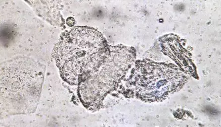 全自動陰道分泌物香蕉爱视频APP剖析陰道分泌物的潔淨度規範