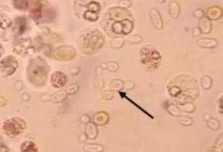 白帶香蕉成人A片视频廠家分析白帶常規檢查及臨床意義