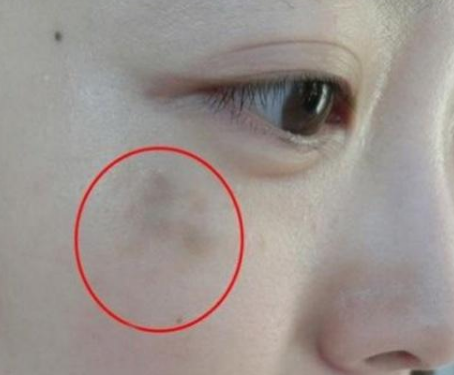 婦科陰道分泌物香蕉爱视频APP提醒女人婦科炎症在臉上的表現