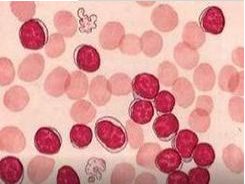 白帶常規香蕉成人A片视频檢測鱗狀上皮細胞增生的病症