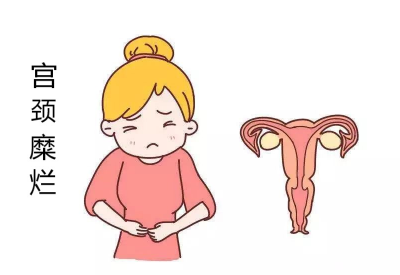 宮頸糜爛會導致宮頸癌?