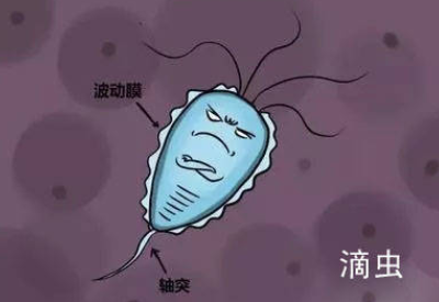 滴蟲性陰道炎的早期症狀以及預防方法 滴蟲性陰道炎的早期症狀以及預防方法