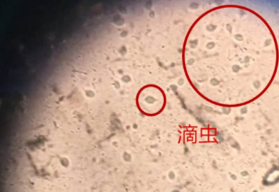 滴蟲性陰道炎是因為體內長了蟲子嗎