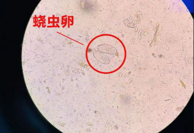 外陰繞蟲病易在兒童身上出現 外陰繞蟲病易在兒童身上出現