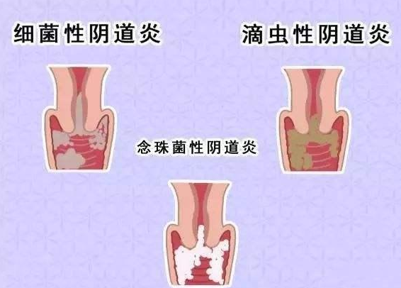 全自動陰道分泌物香蕉爱视频APP廠家提醒您還在拖延嗎，還在等陰道炎自愈嗎？